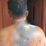 Sempat Diamankan di Polsek Cileungsi: Dugaan Main Hakim Sendiri, Korban Alami Luka Bakar dan Luka Robek